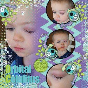 Orbital Celulitus