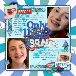 Only 11 Days in Braces