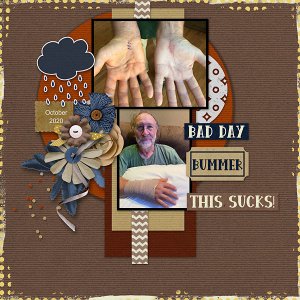 Jim-hand-surgery-copy