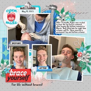 Braces removed