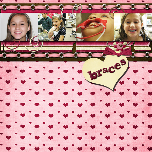 bracesflat2