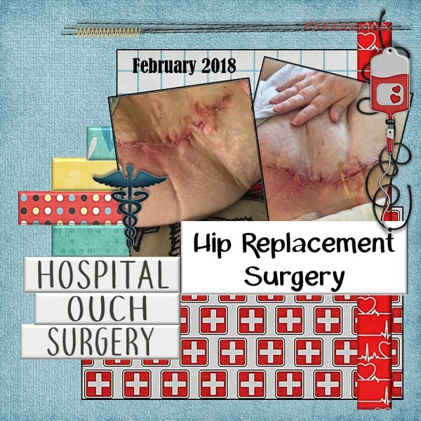 Hip Replacement Surgery - March 2018 Mix It Up Challenge