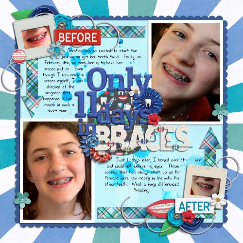 Only 11 Days in Braces