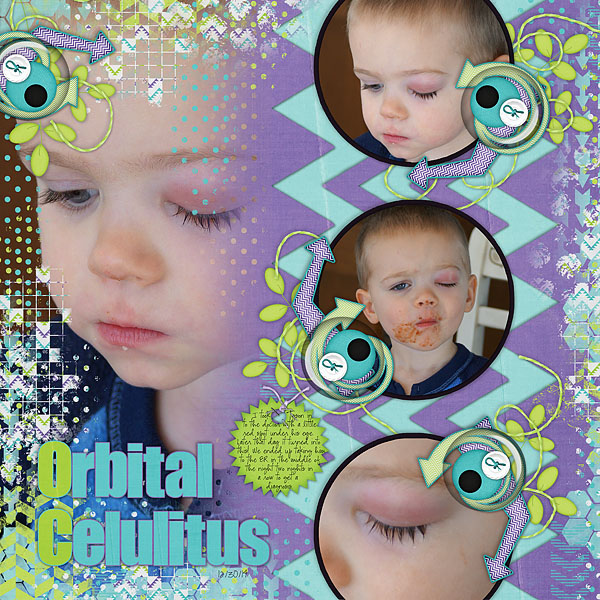 Orbital Celulitus