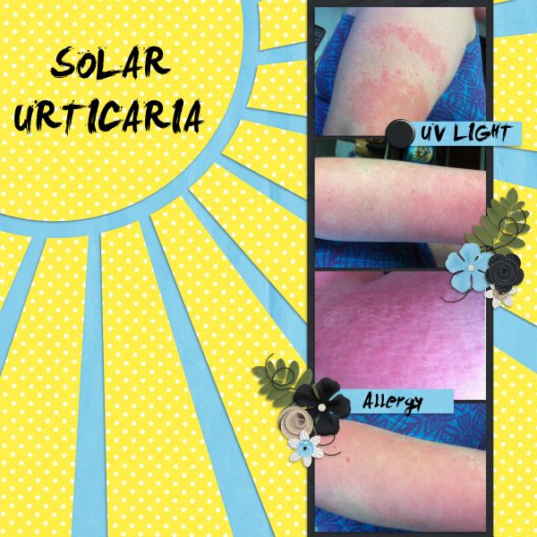 Solar Urticaria